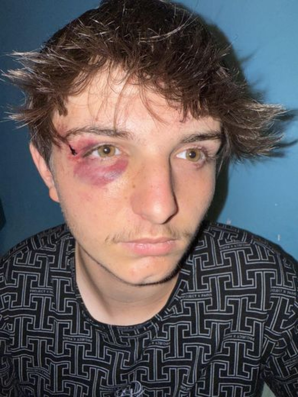 Lynchage Homophobe à Mazamet, un jeune gay brutalement attaqué et harcelé à l’hôpital