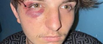 Lynchage Homophobe à Mazamet, un jeune gay brutalement attaqué et harcelé à l’hôpital